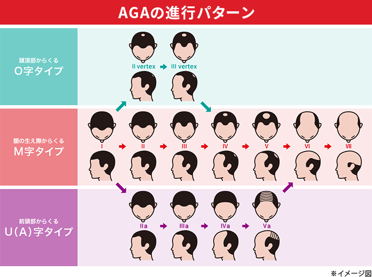 AGAの進行パターンイメージ図