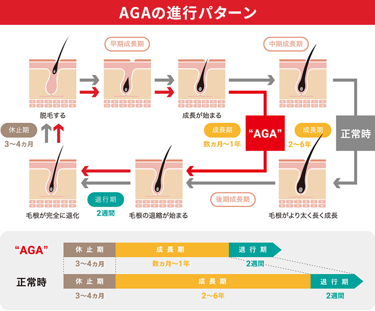 AGAの進行パターンイメージ